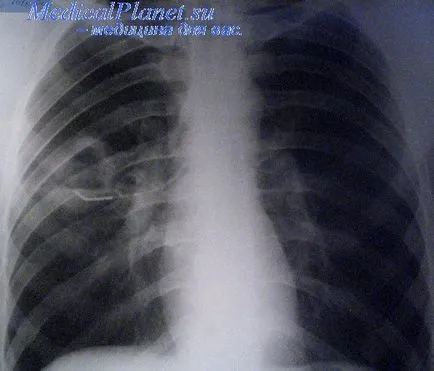 Tratamentul gangrenei pulmonare