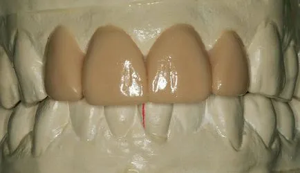 Modelarea dinților de ceară