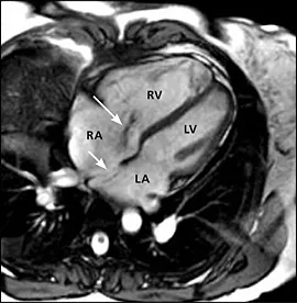 MRI a szív - az ár, árfolyam, dekódolás, előkészítése, ellenjavallatok