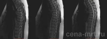 MRI на гръбнака на гръдния кош