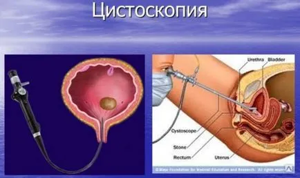 Neurogén hólyag gyermekek és felnőttek, a kezelés, a tünetek