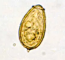 Opisthorchiasis (cat vagy szibériai métely) - tünetek, kezelés