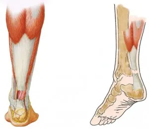 Chirurgia pentru ruptura tendonului lui Ahile