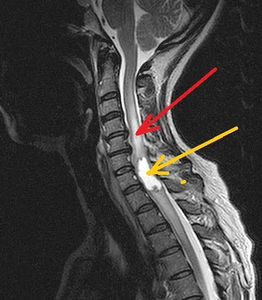 simptome ale coloanei vertebrale tumorale din cordonul ombilical și tratament