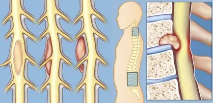 Cauzele tumorale ale măduvei spinării, simptome, tratament, prognosticul
