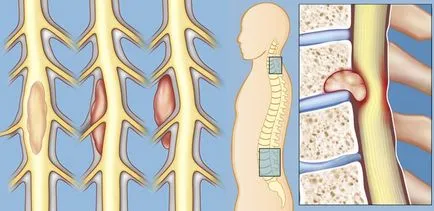 гръбначния мозък туморни причини, симптоми, лечение, прогноза