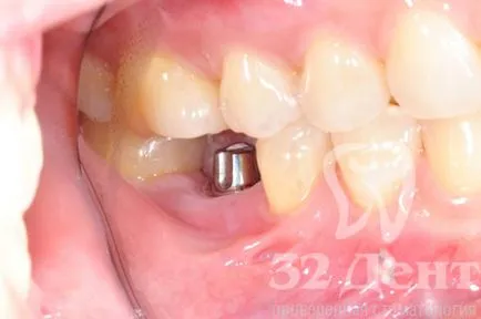 Veszélyes és káros, ha a fogászati ​​implantátumok