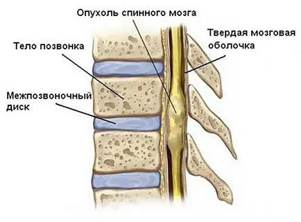 Cauzele tumorale ale măduvei spinării, simptome, tratament, prognosticul
