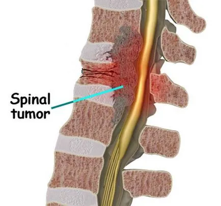 gerincvelő tumor tünetek és a kezelés