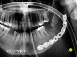 Osteosinteza mandibulei 1