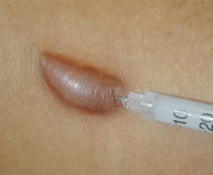 Rămâne dacă cicatricea după îndepărtarea cu laser mole - frumusete pentru suflet