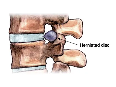 Osteopatie in tehnica hernia spinarii si aplicarea