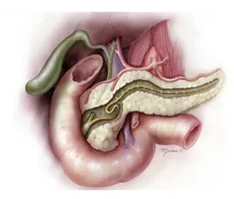 Pancreatonecrosis стъпки панкреаса - токсемия, абсцес и промени гнойни