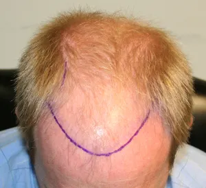 трансплантация на коса снимки преди и след процедурата, указания за употреба и експлоатация