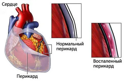 Pericarditis gyermekek - tünetek megelőzésére és kezelésére pericarditis gyermekek, okai