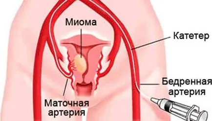 pregătire ureter plastică pentru operații, metode