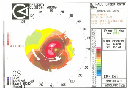 Am câștigat keratoconus - un blog Mikhail Titov (Scoala de Sanatate Titov)