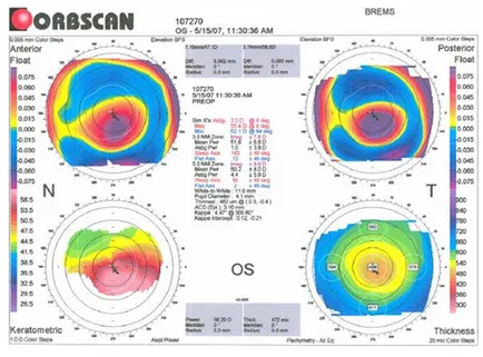 Am câștigat keratoconus - un blog Mikhail Titov (Scoala de Sanatate Titov)