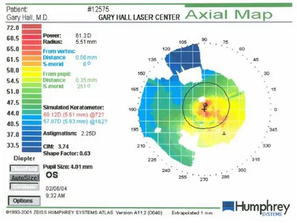 Am câștigat keratoconus - un blog Mikhail Titov (Scoala de Sanatate Titov)