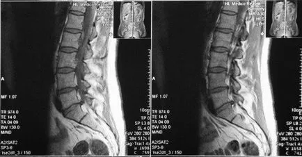 Jelzések az MRI az ágyéki, keresztcsont, farkcsont képzés és hogyan