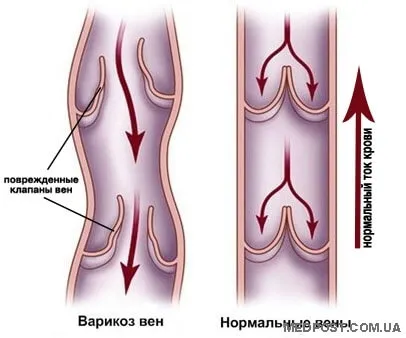 Правилното предотвратяване на разширени вени