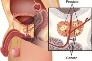 Рак на простатата и нейното лечение, портал за психология и медицина
