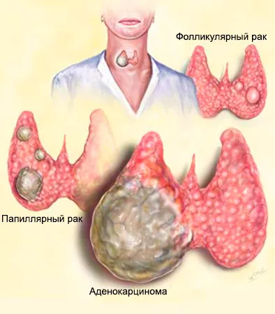 Cancerul tiroidian trăi mult după o intervenție chirurgicală, reabilitare și prognosticul