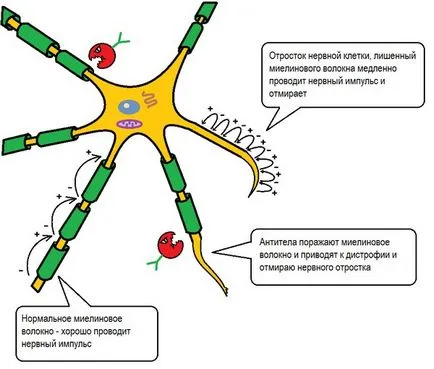 A sclerosis multiplex tünetei és okai a nők, a korai stádiumú