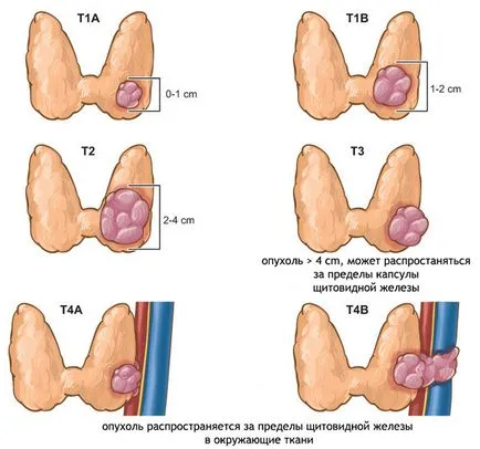 Cancerul tiroidian trăi mult după o intervenție chirurgicală, reabilitare și prognosticul