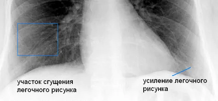 Radiografia toracica un fumător - o analiză detaliată