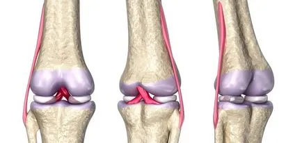 Ruperea ligamentelor laterale ale articulației genunchiului, decalajul lateral, ligamentele articulare exterioare și interioare,