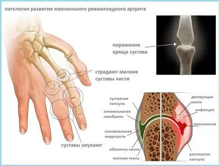 Artrita reumatoida - simptome, tratament, Diagnostic