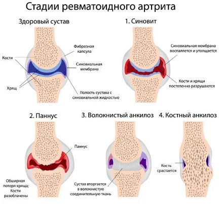 Ревматоидният артрит, подагрен артрит на ставите, артрит, инфекциозни - симптоми и лечение