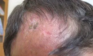 alopecie Scar special, cauzele