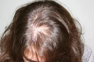 alopecie Scar special, cauzele