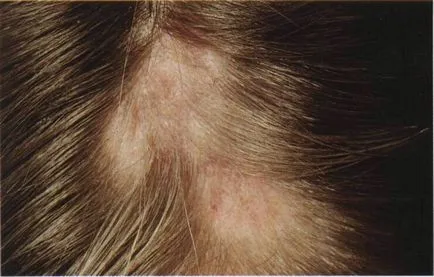 alopecie Scar special, cauzele