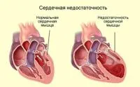 Сърдечна оток - симптоми, причини и лечение