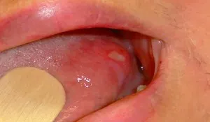 tünetei stomatitis