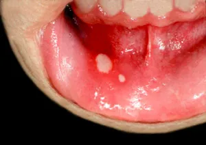 tünetei stomatitis