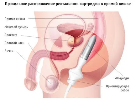 Смарт прост физиотерапия урологичната система