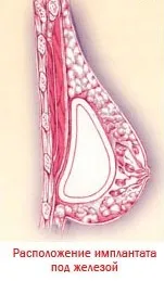 Telepítésének módszerei az implantátumok - blog design omorfia