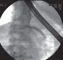 Stentarea principal canalul pancreatic în tratamentul pancreatitei acute, care a apărut după