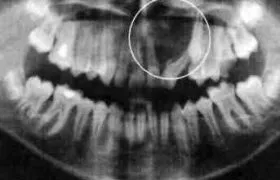 Dental заболяванията - odontoma, saphris (азенапин) - лечение на шизофрения