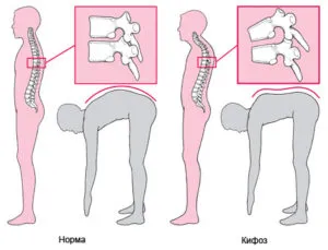 Képzés kyphosis 1., 2., 3. és 4. fok, fotó az első fokú kyphosis