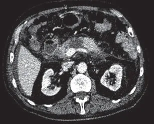 Stentarea principal canalul pancreatic în tratamentul pancreatitei acute, care a apărut după