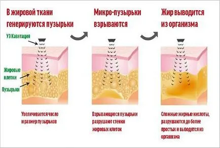 slăbire cavitatie cu ultrasunete și a celulitei