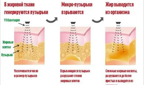 slăbire cavitatie cu ultrasunete și a celulitei