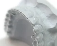 Aligners за коригиране на захапка