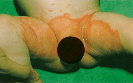 Candida dermatitis gyermekek és annak kezelése