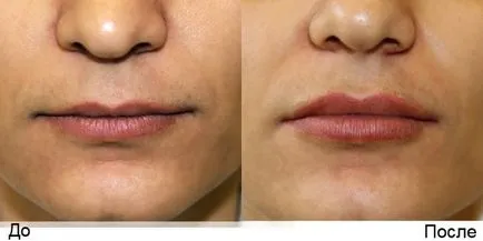 Lip augmentare cu acid hialuronic - Poze inainte si dupa